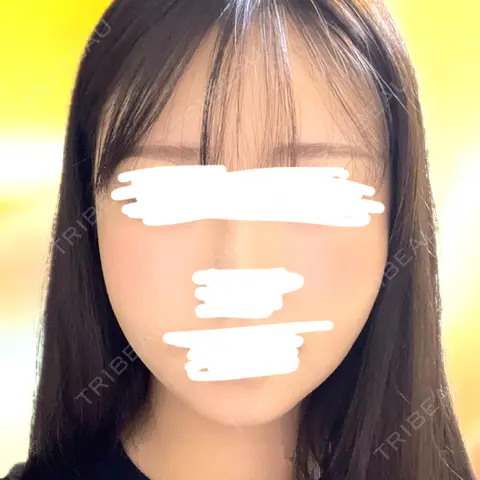 骨切り（あご） / 骨削り（エラ） / 骨削り（頬） セギム美容整形外科 DAY 30