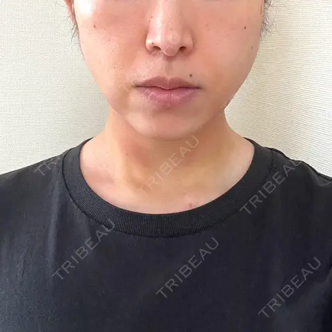 糸リフト / バッカルファット除去 / 脂肪吸引注射（顔） / ボトックス（あご） 湘南美容クリニック Regno 銀座院 DAY 2