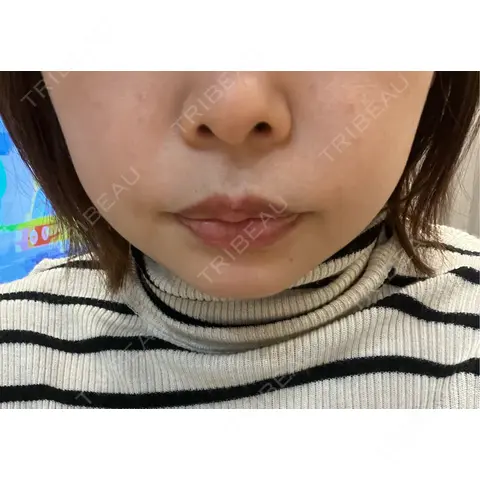 その他（肌） ルラ美容クリニック 仙台院 AFTER