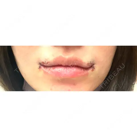 口角挙上 R Beauty CLINIC 銀座院 DAY 0