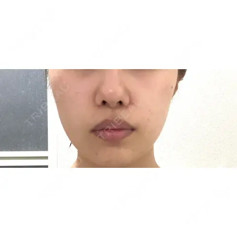 ボトックス（エラ・小顔） / ボトックス（肩） / ワキ汗治療（ボトックス） おおたかの森ビューティークリニック AFTER