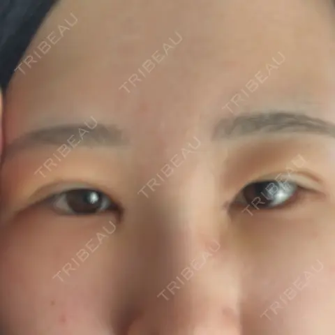 二重埋没 / 目頭切開 / 上まぶたの脂肪取り HAAB×DREAM BEAUTY CLINIC 東京本院 DAY 7