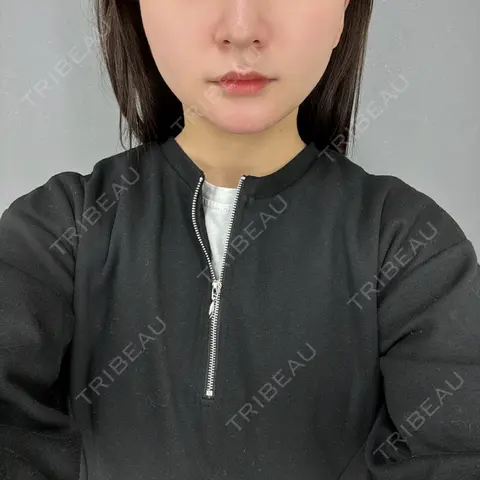 脂肪吸引（顔） / 脂肪吸引注射（顔） ziz CLINIC AFTER