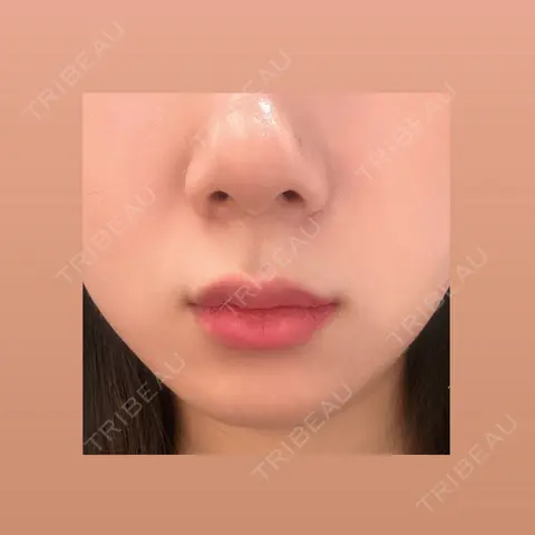 脂肪吸引（顔） / 脂肪吸引注射（顔） ziz CLINIC AFTER