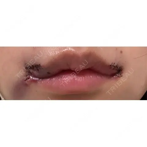口角挙上 / ヒアルロン酸注入（唇） R Beauty CLINIC 銀座院 DAY 2