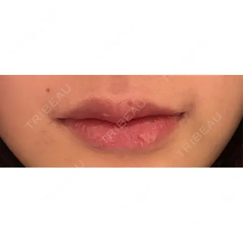 口角挙上 / ヒアルロン酸注入（唇） R Beauty CLINIC 銀座院 AFTER