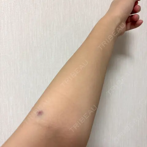 美容点滴・美容注射（美肌） ビー・ファインクリニック AFTER