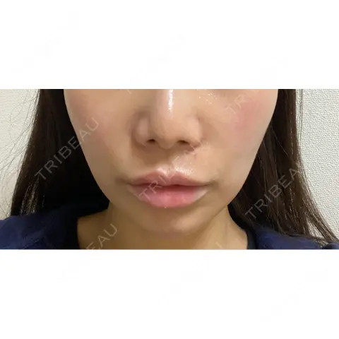 ヒアルロン酸注入（唇） / ヒアルロン酸注入（鼻翼基部） DMTC美容皮膚科 日本橋院 AFTER
