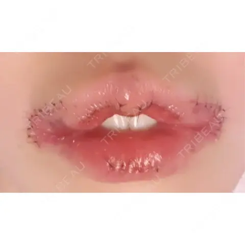口角挙上 / その他（口元） R Beauty CLINIC 銀座院 DAY 1