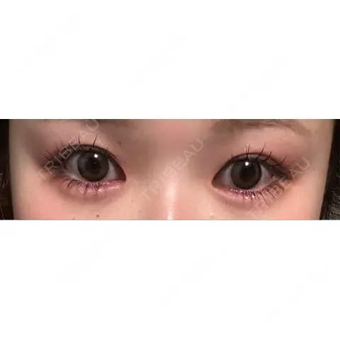 ヒアルロン酸注入（涙袋） ルラ美容クリニック 大阪本院 AFTER