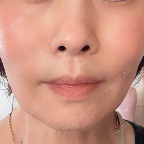糸リフト Brandnew Beauty Clinic DAY 0