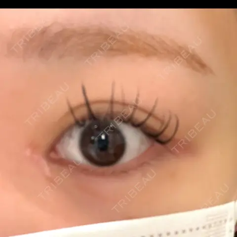 目頭切開 9BeautyClinic AFTER