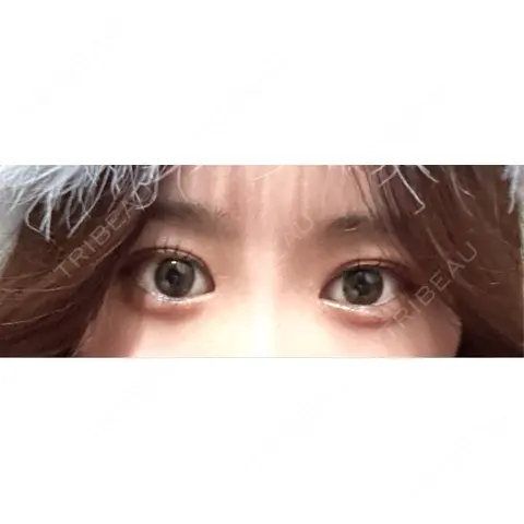 二重埋没 / クマ治療 東京シンデレラ美容外科 池袋院 AFTER