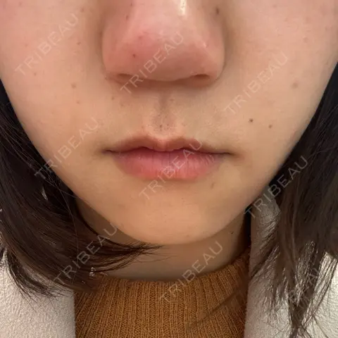 脂肪溶解注射（顔） 目白ホワイトクリニック DAY 0