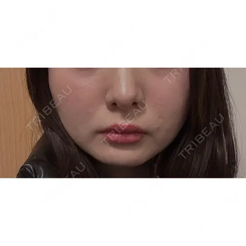 RF（高周波）たるみ治療 RIVER CLINIC（リバークリニック） AFTER