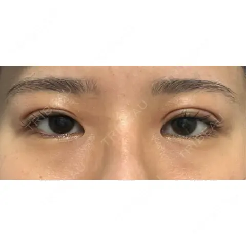 二重埋没 THE FIRST CLINIC 多摩センター院 DAY 0