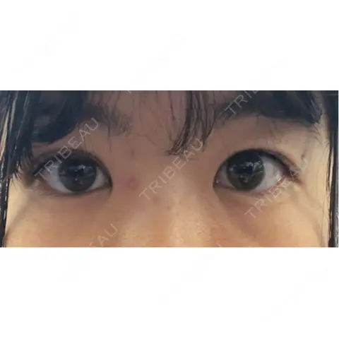 二重埋没 Shion Beauty Clinic AFTER