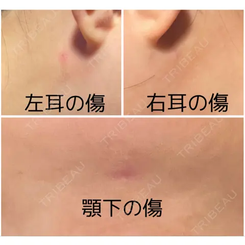 糸リフト / 脂肪吸引（顔） / 脂肪吸引注射（顔） / ヒアルロン酸注入（あご） / ボトックス（エラ・小顔） SEA CLINIC（シークリニック） AFTER
