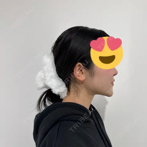 糸リフト / 脂肪吸引（顔） / ジョールファット除去 / 脂肪吸引注射（顔） SEA CLINIC（シークリニック） AFTER
