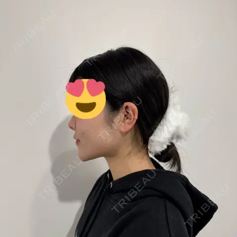 糸リフト / 脂肪吸引（顔） / ジョールファット除去 / 脂肪吸引注射（顔） SEA CLINIC（シークリニック） AFTER