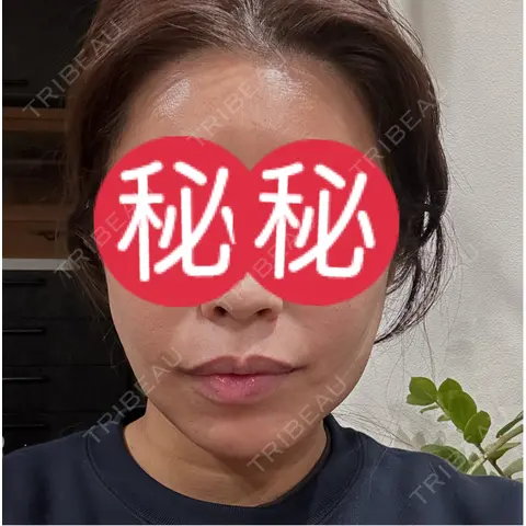 糸リフト / 脂肪吸引（顔） / ジョールファット除去 / 脂肪吸引注射（顔） / ボトックス（あご） SEA CLINIC（シークリニック） DAY 2