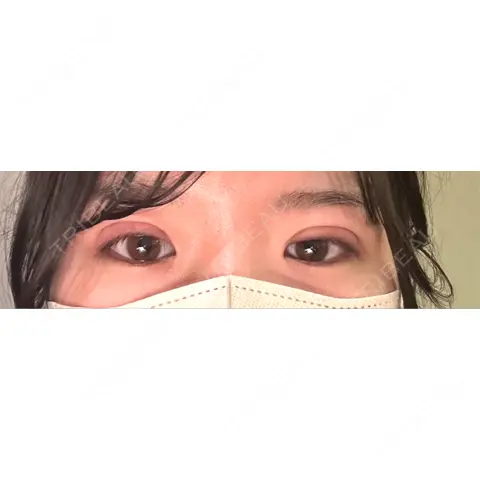 二重埋没 オーキッド美容クリニック東京御徒町 DAY 1