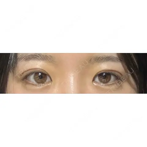 二重埋没 オーキッド美容クリニック東京御徒町 AFTER