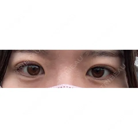 二重埋没 オーキッド美容クリニック東京御徒町 AFTER