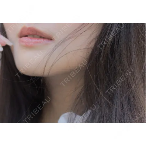 脂肪吸引（顔） / 脂肪吸引注射（顔） ziz CLINIC AFTER