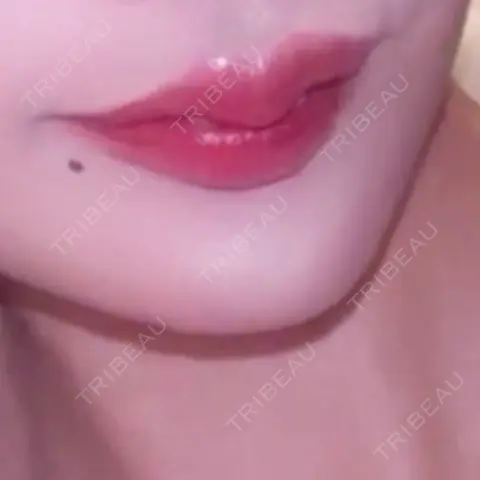 ヒアルロン酸注入（唇） HAAB×DREAM BEAUTY CLINIC 大阪梅田院 AFTER