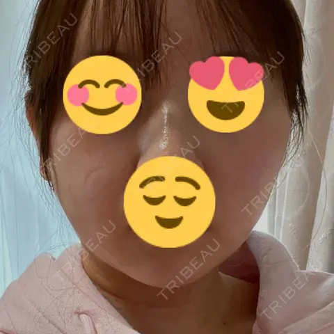 RF（高周波）たるみ治療 RIVER CLINIC（リバークリニック） AFTER
