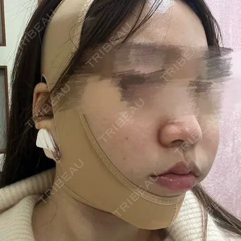 糸リフト / 脂肪吸引（顔） SEA CLINIC（シークリニック） DAY 0
