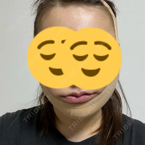 糸リフト / 脂肪吸引（顔） / 脂肪注入（輪郭） 東京ココセランクリニック DAY 0