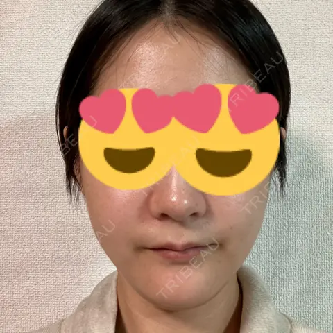 ハイフ（顔） LE CLINIC AFTER