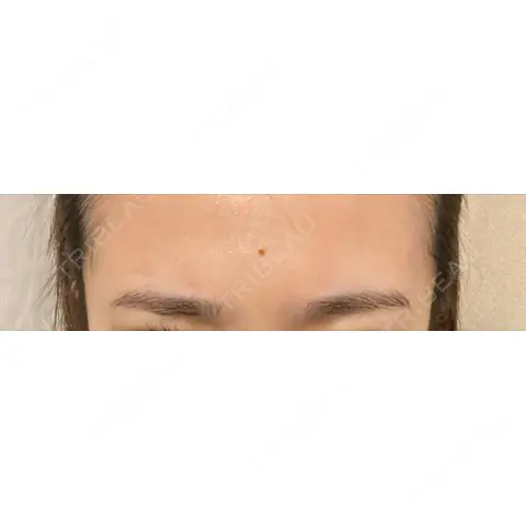 シワ取りボトックス / ボトックス（眉間） / ボトックス（ガミースマイル） LE CLINIC AFTER