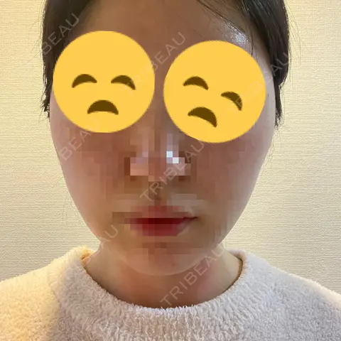脂肪吸引（顔） Casa de GRACIA GINZA 【カーサデグラシアギンザ】 DAY 1