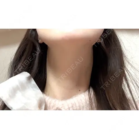 RF（高周波）たるみ治療 ルラ美容クリニック 福岡院 AFTER
