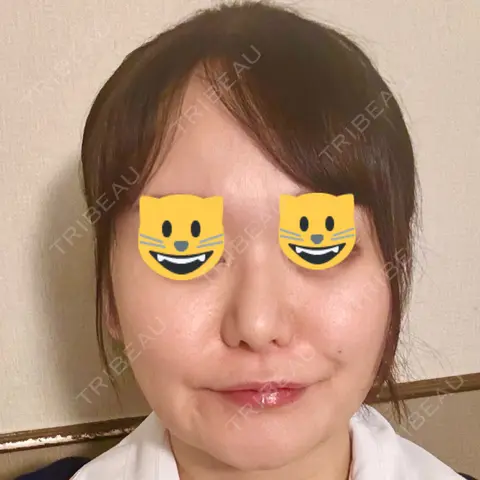 糸リフト / クマ治療 / 脂肪吸引（顔） / 脂肪注入（目の下） / ヒアルロン酸注入（涙袋） / ヒアルロン酸注入（唇） 東京シンデレラ美容外科 池袋院 AFTER