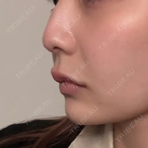 ヒアルロン酸注入（あご） / ヒアルロン酸注入（唇） / ボトックス（口角） ルラ美容クリニック 名古屋栄院 AFTER