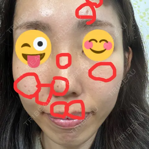 ほくろ・いぼ切除（肌） KARIS beauty clinic AFTER