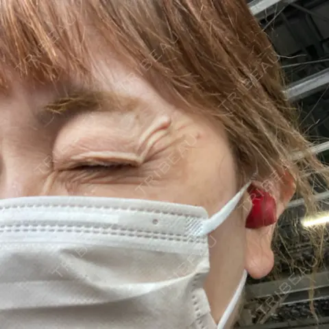 ボトックス（目尻） Re:anne clinic 銀座 【リアンクリニック銀座】 AFTER