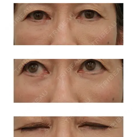 下まぶたたるみ取り WOM CLINIC GINZA （ワム クリニック ギンザ） AFTER