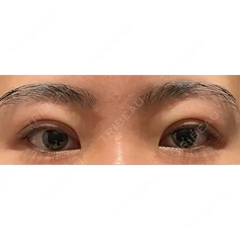 二重埋没 WOM CLINIC GINZA （ワム クリニック ギンザ） DAY 0