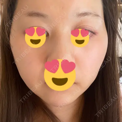 RF（高周波）たるみ治療 RIVER CLINIC（リバークリニック） AFTER