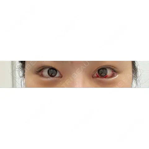 目頭切開 / タレ目形成・グラマラスライン（切開） R Beauty CLINIC 大阪院 DAY 6