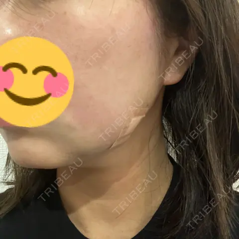 脂肪吸引（顔） PRISM Beauty Clinic DAY 0