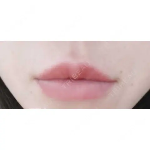 ボトックス（あご） / ヒアルロン酸注入（唇） おおたかの森ビューティークリニック AFTER