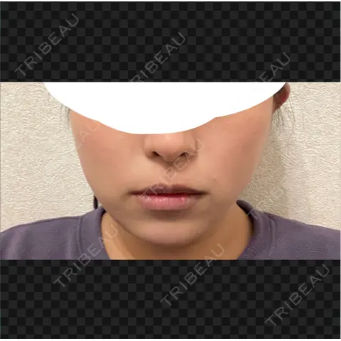 糸リフト / 脂肪吸引（顔） / 脂肪吸引注射（顔） / ヒアルロン酸注入（あご） / ボトックス（エラ・小顔） SEA CLINIC（シークリニック） AFTER
