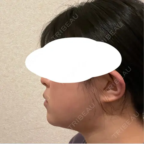 糸リフト / 脂肪吸引（顔） / 脂肪吸引注射（顔） / ヒアルロン酸注入（あご） / ボトックス（エラ・小顔） SEA CLINIC（シークリニック） AFTER