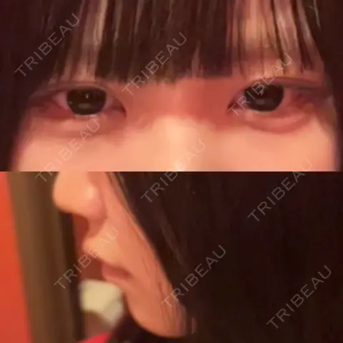 ヒアルロン酸注入（涙袋） / ヒアルロン酸注入（唇） HAAB×DREAM BEAUTY CLINIC 大阪梅田院 DAY 0
